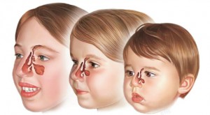 اعراض التهاب الجيوب الانفيه عند الاطفال