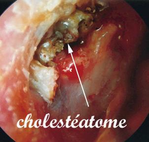 Pathologies du tympan, perforation, rétraction et cholestéatome