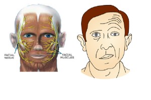 paralysie faciale anatomie