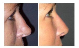rhinoplastie chirurgie esthétique nez